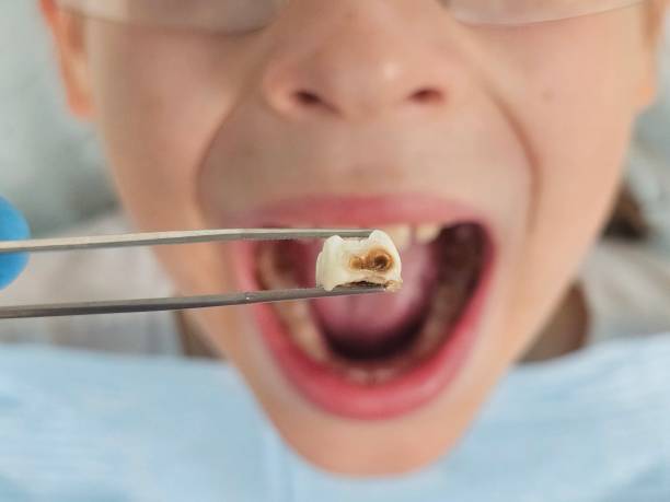 Best Emergency Tooth Extraction in Vashon, WA